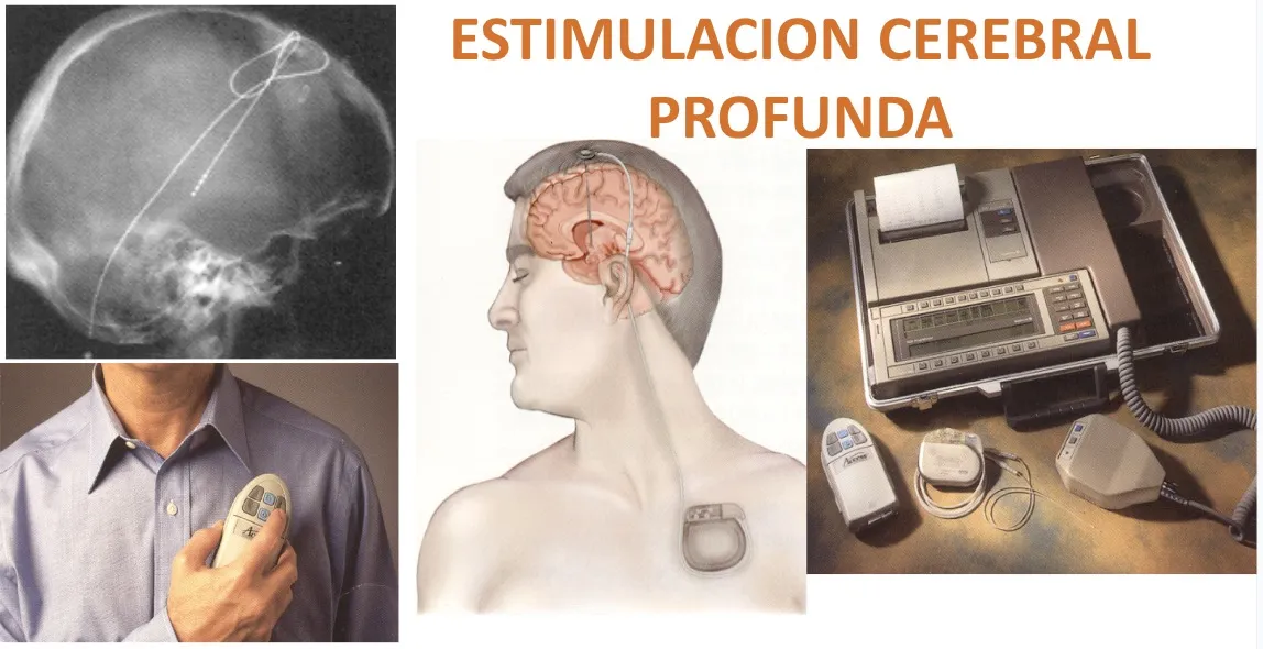 Figura 18.- Sistema de estimulación cerebral profunda mediante electrodos implantados de forma crónica