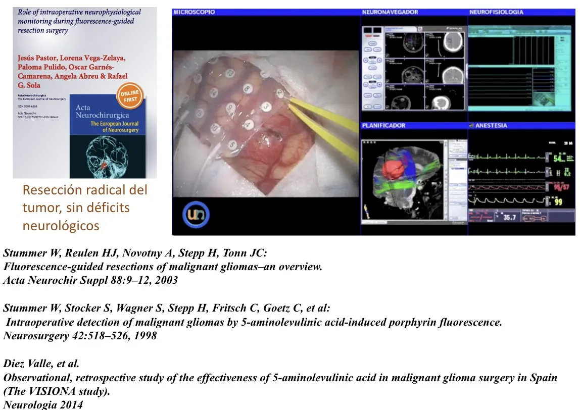 Figura 19.- Influencia de la neurocirugía funcional sobre la neurocirugía general: resección radical del tumor sin producir déficits neurológicos
