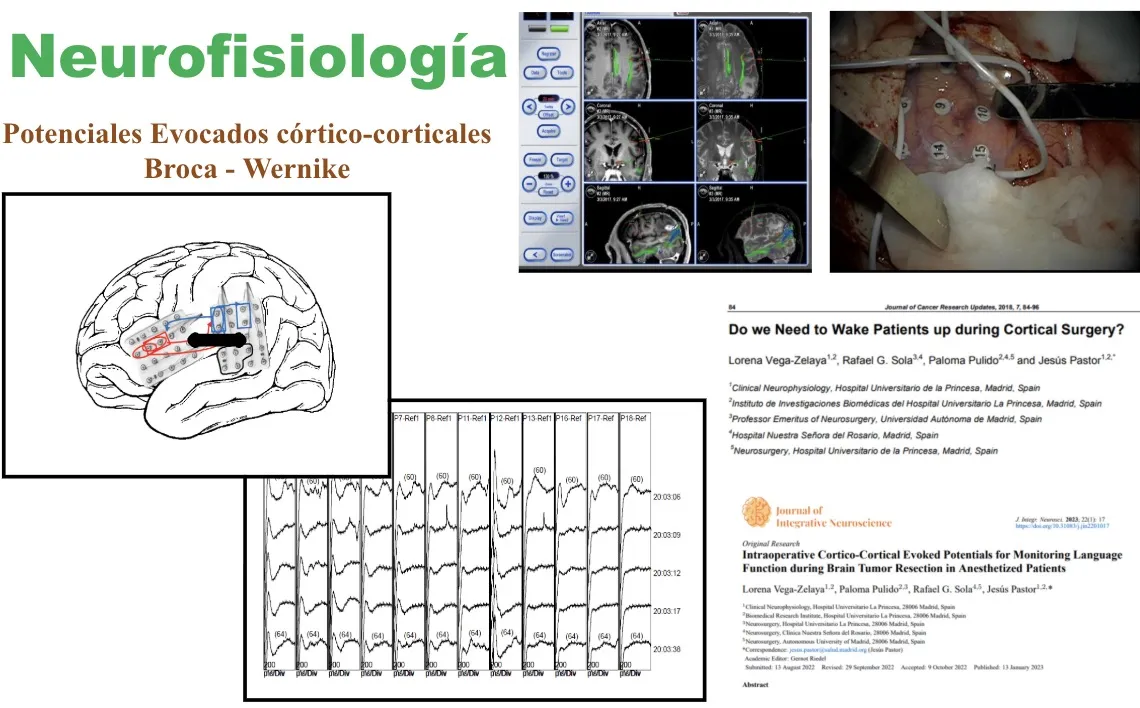 Figura 21.- Registro de potenciales evocados córtico-corticales para el control intraoperatorio de las áreas del lenguaje (Broca-Wernicke)