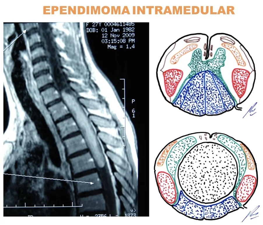 Figura 24.- Caso de ependimoma intramedular abordado con control de la función medular
