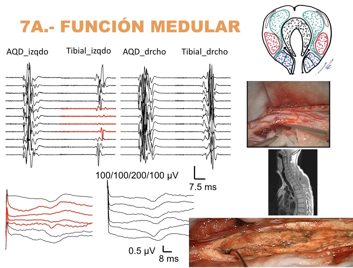 Figura 25.- Registro neurofisiológico continuo (potenciales de las vías tibial y AQD) durante la resección de un tumor intramedular