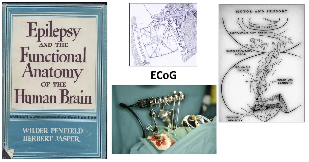 Figura 6.- Registro de electrocorticografía (ECoG) empleado para conocer la función de la corteza cerebral durante la intervención quirúrgica