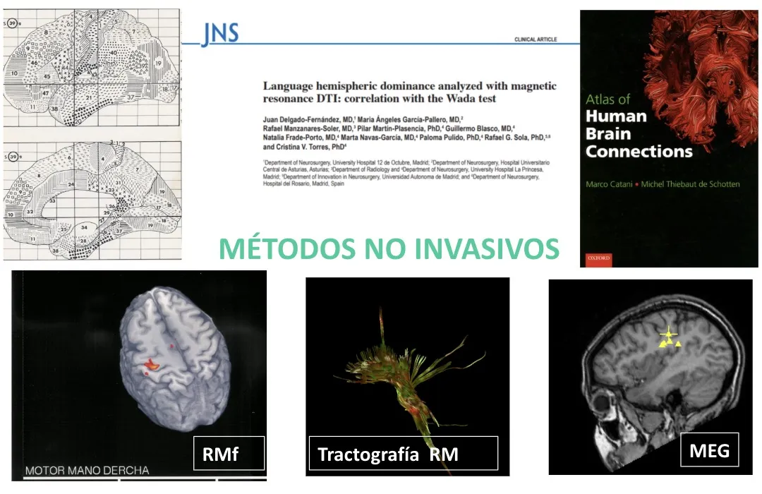 Figura 7.- Métodos no invasivos de estudio de la función cerebral: resonancia magnética funcional (RMf), tractografía por RM y magnetoencefalografía (MEG)