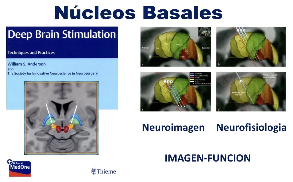 Figura 8.- Correlación entre neuroimagen y neurofisiología para la localización precisa de los núcleos basales profundos del cerebro